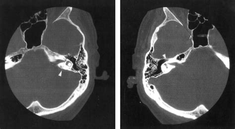 Left Transverse Left Temporal Bone Fracture White Arrow Head On The