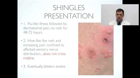 The patient was treated with oral acyclovir. Shingles (Herpes Zoster) Diagnosis and Overview- OnlineDermClinic - YouTube