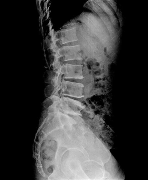 Treating A Sequestered Spinal Disc Fragment Dr Sinicropi