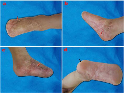 Figure 3 From Management Of Degloving Injuries Of The Foot With A