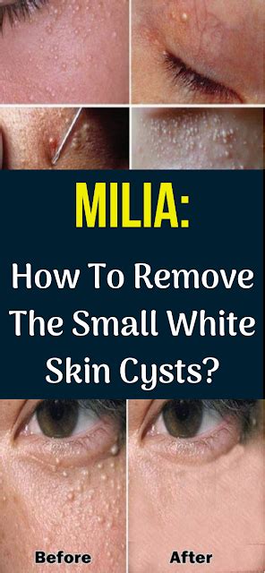 How To Treat Milia Cysts Naturally