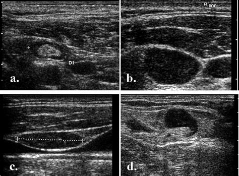 Lymph Node Hilum Ultrasound