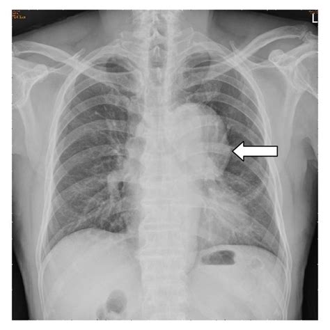 Chest Radiography Revealed A Large Bulging Contour Overlying Aorta And