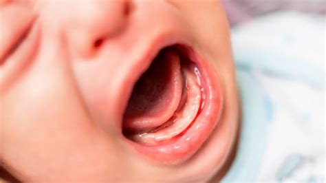 Do Babies Gums Bleed When They Cut Teeth Teethwalls