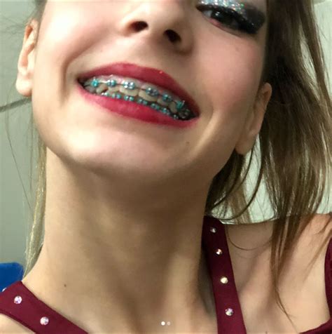 Pin By Evil H On Beautiful Braces Braces Girls Dental Braces Orthodontics