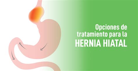 Opciones De Tratamiento Para La Hernia Hiatal
