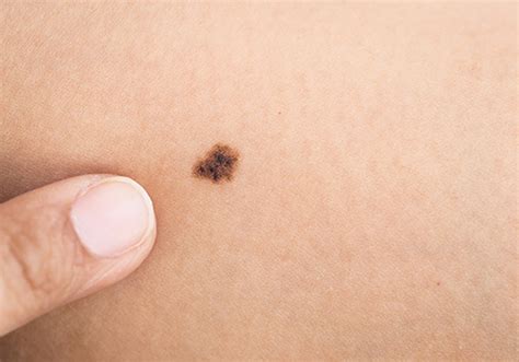 Types Of Skin Cancers