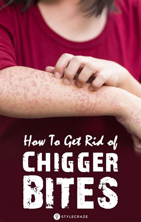 How To Get Rid Of Chigger Bites Do You Want To Know More About