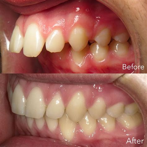 How To Fix An Overbite Using A Carriere Distalizer And Invisalign