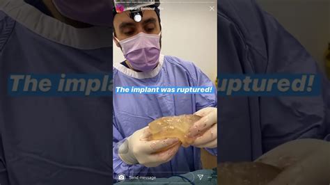 breast implant removal warning ⚠️ graphic footage to follow watch at your own risk youtube