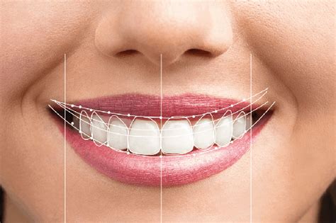 Smile Makeover Cosmetic Dental Implant Centre Cdic Wakad