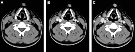 Castleman Disease Of The Neck Ct And Mr Imaging Findings European