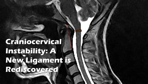 Symptoms And Conditions Of Craniocervical And Cervical Instability My
