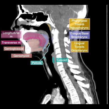 Anatomy Nasopharynx Ct Pics