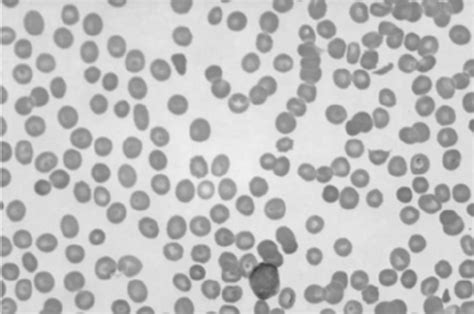 The Initial Peripheral Blood Film Which Shows Pancytopenia And