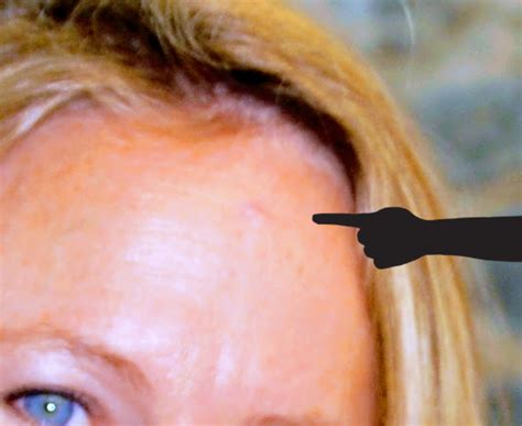 Skin Cancer Bumps On Head Idaman