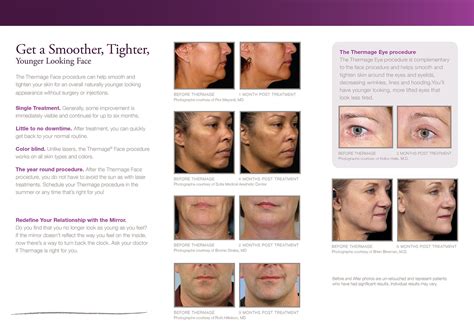 Thermage Procedures Can Help Smooth Tighten And Deep Contour Skin For