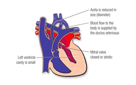 Cardiac Case Study Hypoplastic Left Heart Syndrome Chop Open