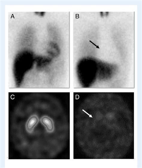 Representative Cases Of Mibg Myocardial Scintigraphy And Dat Spect