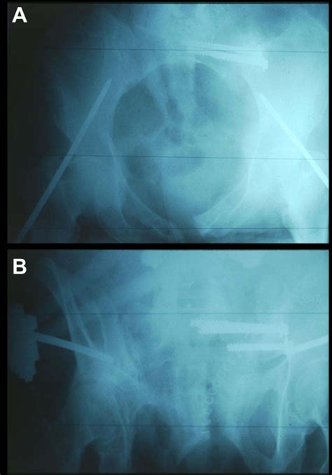 Pelvic Inlet Panel A And Outlet Panel B X Ray Views After Posterior