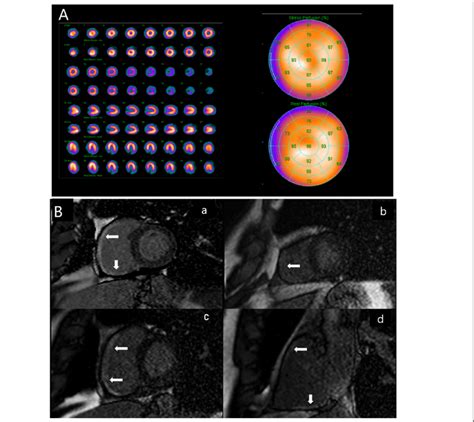 Single Photon Emission Computed Tomographycomputed Tomography Imaging