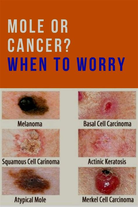 Skin Cancer Cells Vs Normal Cells My Xxx Hot Girl