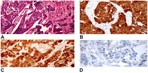 Prognostic Significance Of P16 Protein Expression In Breast Cancer In
