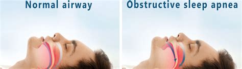 obstructive sleep apnea osa dunedin fl symptoms and risks