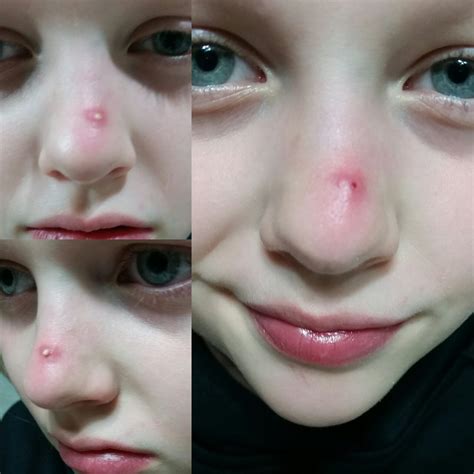 My 10 Year Old Daughter Had Her 1st Big Pimple And She Let Me Help Her