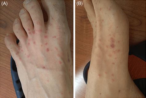 Acral Areas Of Erythema With Some Vesicles And A Purpuric Component