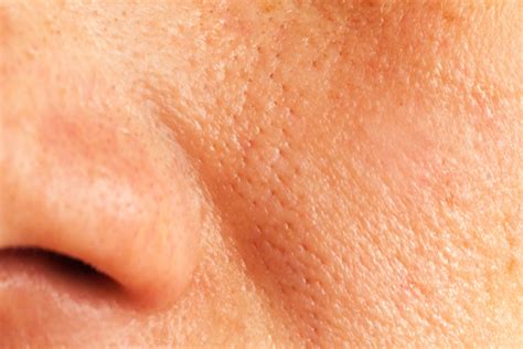 How To Get Rid Of Enlarged Pores Naturally At Home Hergamut