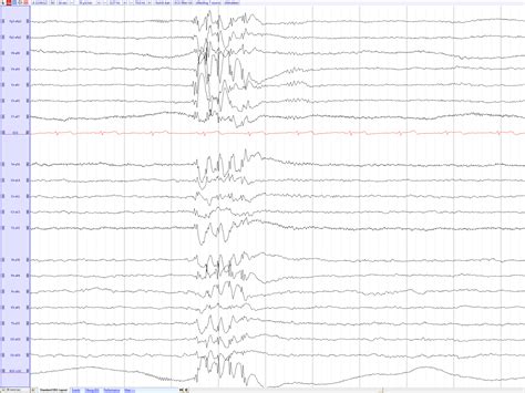 Juvenile Myoclonic Epilepsy Eegpedia