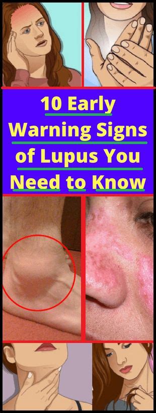 10 Early Warning Signs Of Lupus You Need To Know Warning Signs