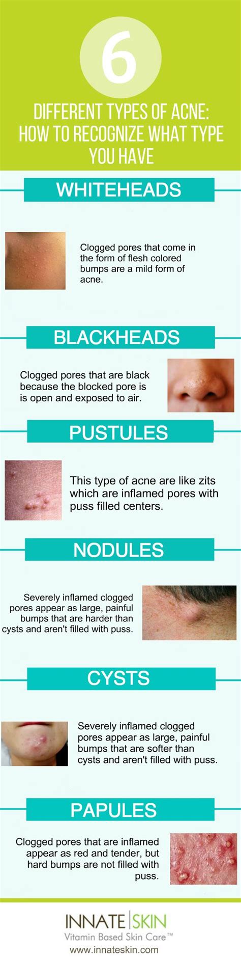 The Different Types Of Acne Types Of Acne Different Types Of Acne