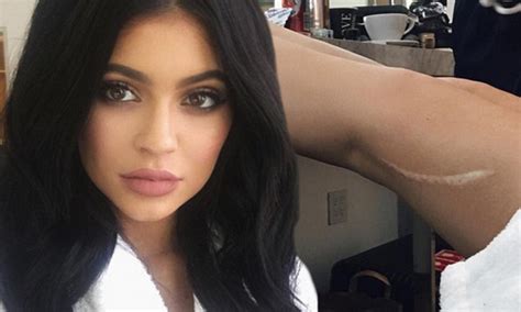 Kylie Jenner Shows Scar She Received While Playing With Kendall Daily Mail Online