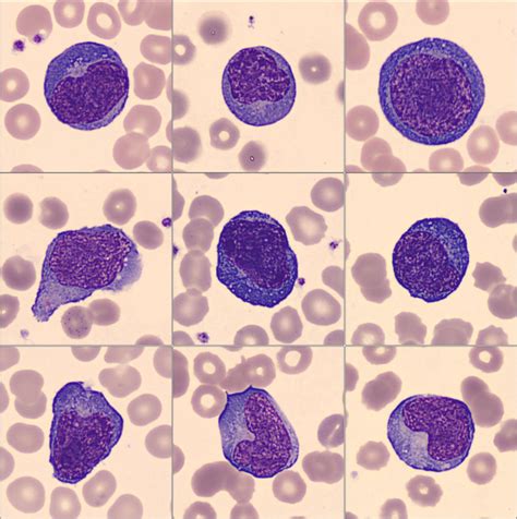Atypical Lymphoid Cells Circulating In Blood In COVID Infection Morphology Immunophenotype