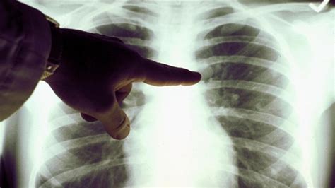 Woman Lives Six Days Without Her Lungs