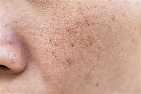 What Is Difference Between Pigmentation And Melasma Le Beau Visage