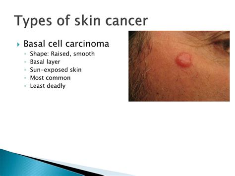 Ppt Skin Cancer Powerpoint Presentation Free Download Id2070610
