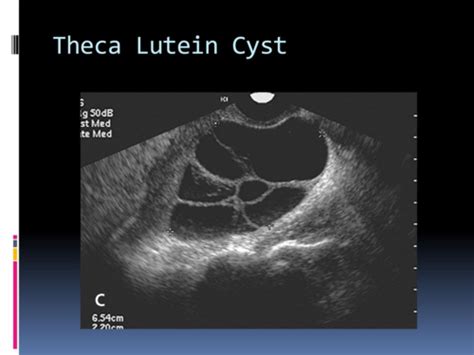 Theca Luteum Cyst