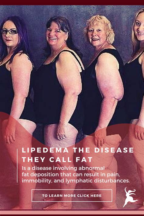 Pin On Lipedema The Disease They Call Fat