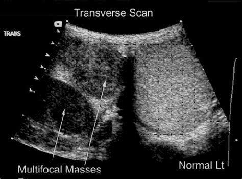 Testicular Cancer On Ultrasound