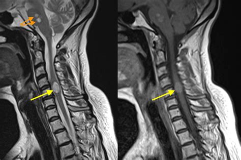 Spinal Cord Metastasis Mri Radiology At St Vincent S University Hospital