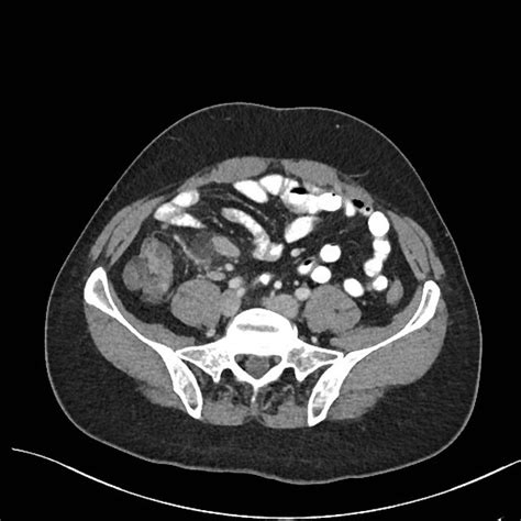 Mesenteric Adenitis Radiology Reference Article