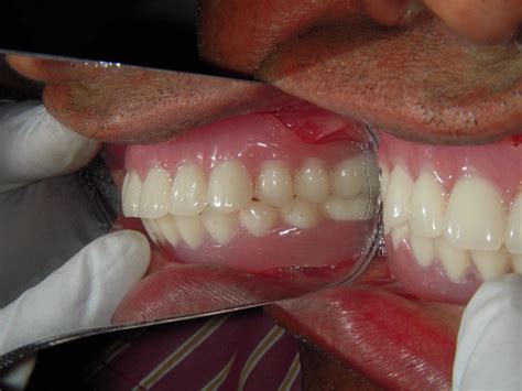 Treated Cases Implant Restore Dental Treatment Centre Rajkot