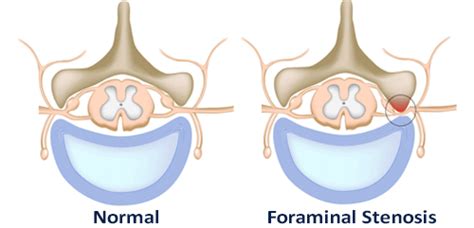What Causes Foraminal Narrowing Foraminal Stenosis Causes