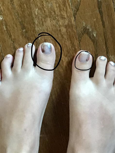 25 How Common Is Cancer Under Toenail Pics Cancer Symptom