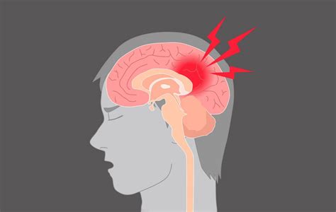 Uobičajeni problemi koji se javljaju nakon moždanog udara oporavak i