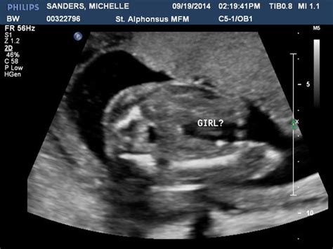 Girl Or Boy Ultrasound At 20 Weeks Along Due Feb 5th 2015