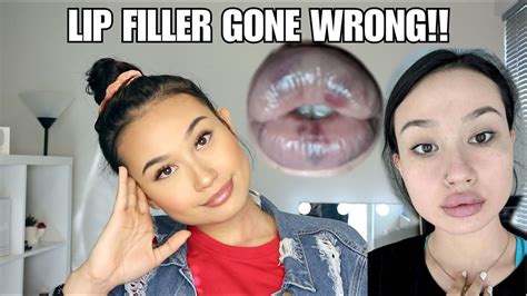 The Truth About My Lips Botched Lip Filler Gone Wrong Storytime